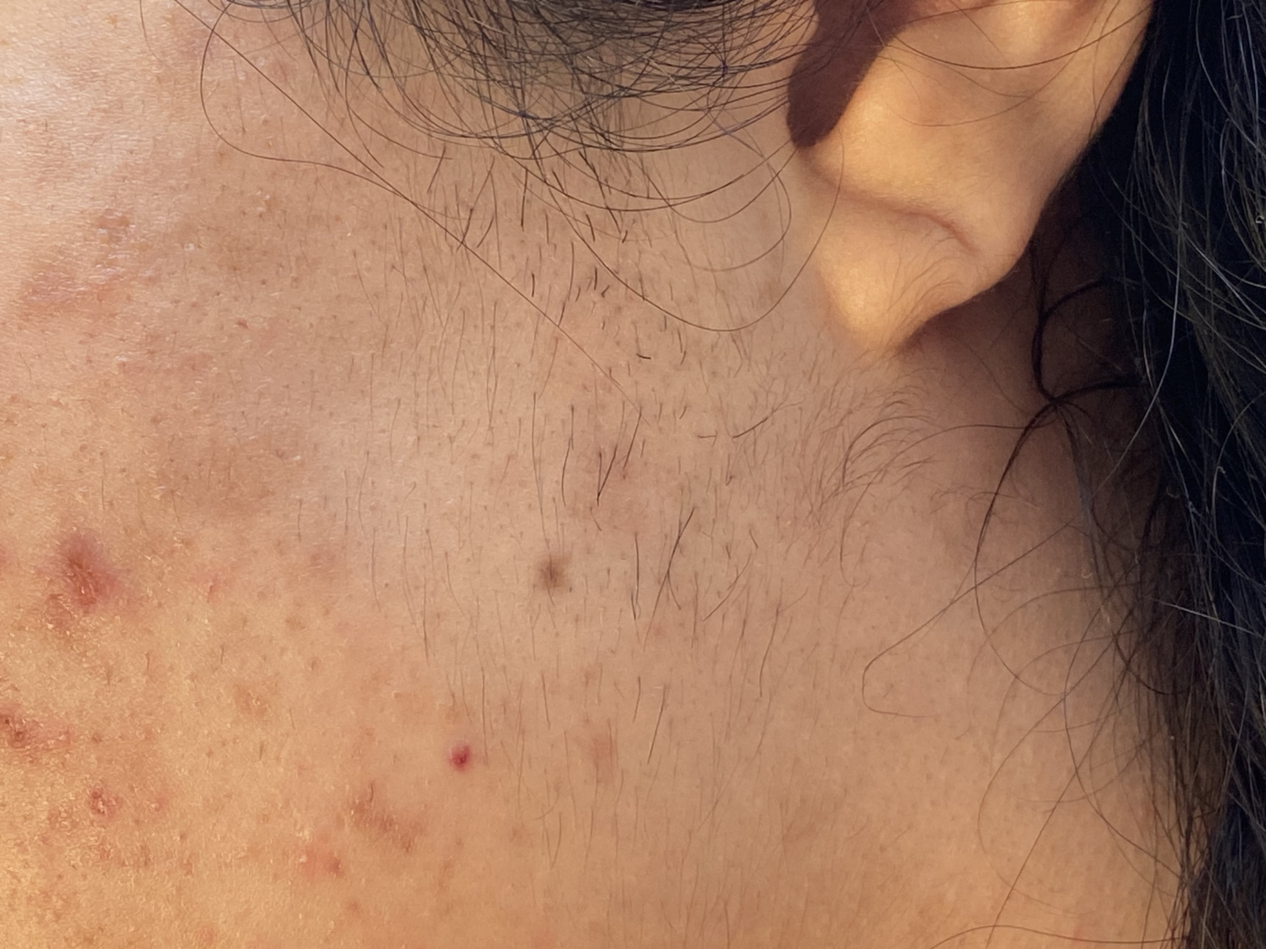 Chin, Lips, Sideburns: Permanent Electrical Hair Removal Zone by Zone