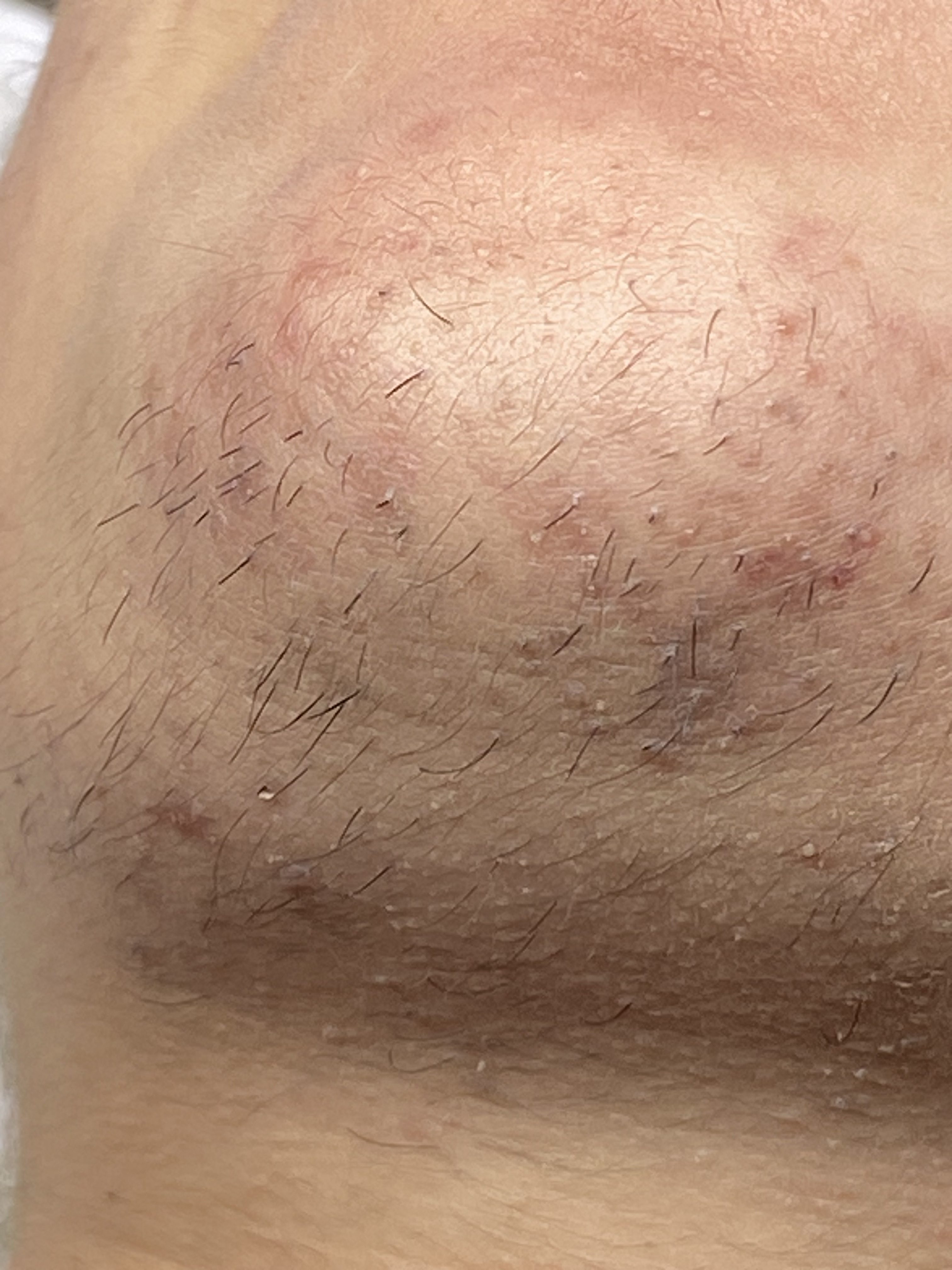 Thermolyse vs laser — quelle est la vraie différence pour une épilation définitive à Luxembourg ?