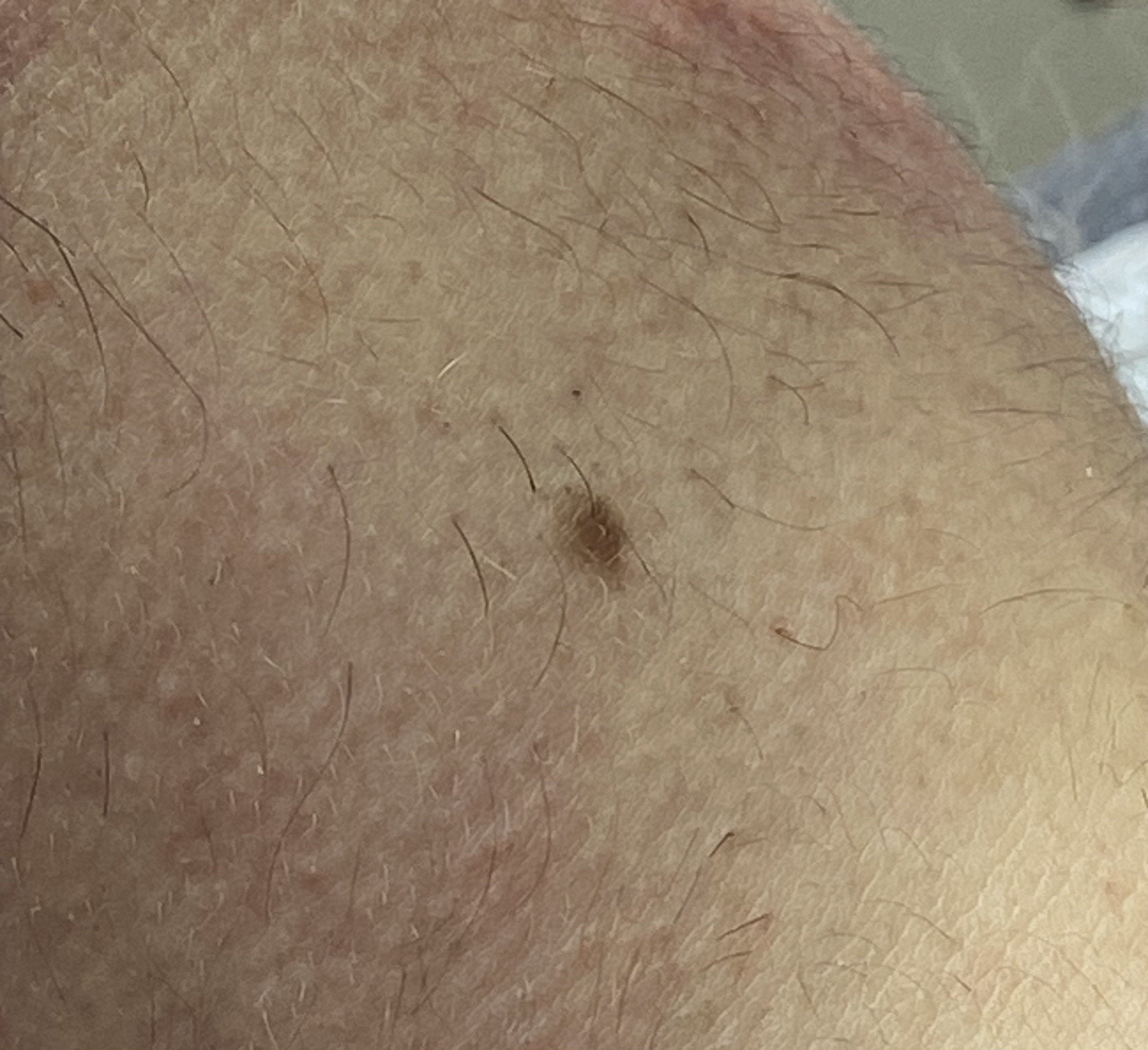 Epilation électrique, thermolyse, blend, tout savoir